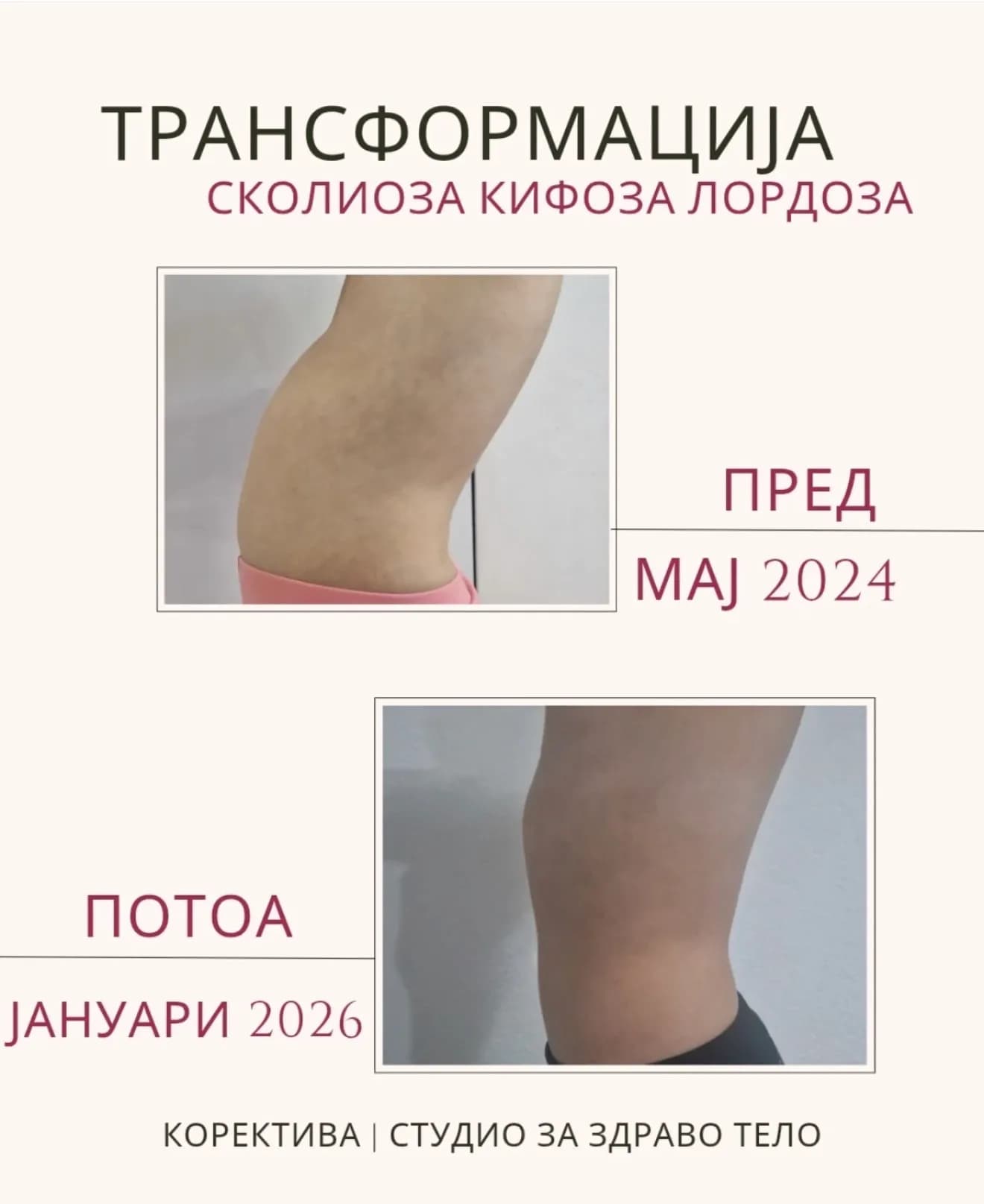 Корекција на рбетен столб