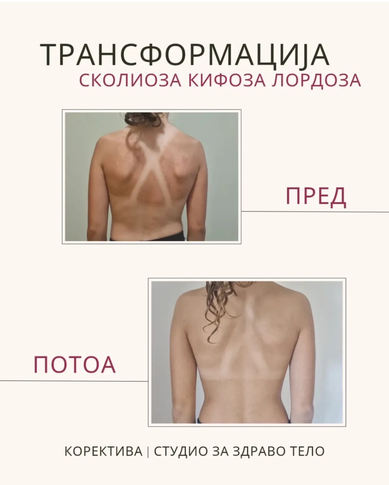 Корекција на рбетен столб